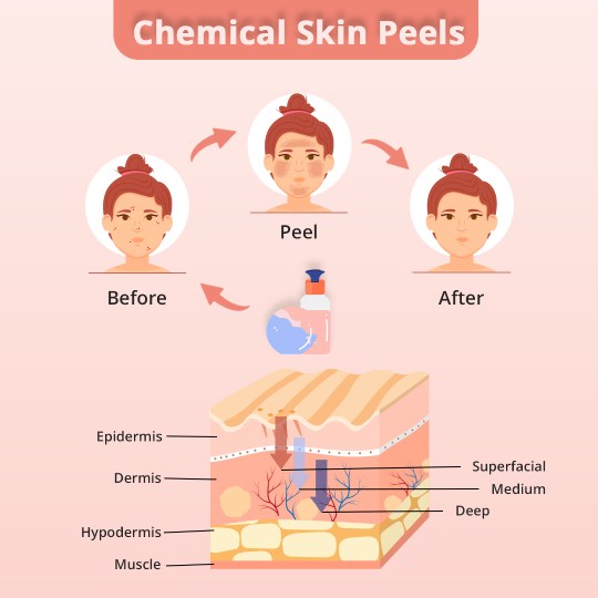 Happens During Chemical Peel Treatment in Hyderabad: clearing skin for Free of Dirt, Grease, and Residues of Skin Cosmetics.